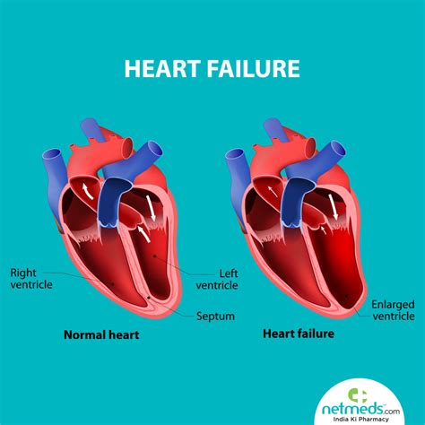 asymptomatic lv dysfunction|decreased left ventricular systolic function.